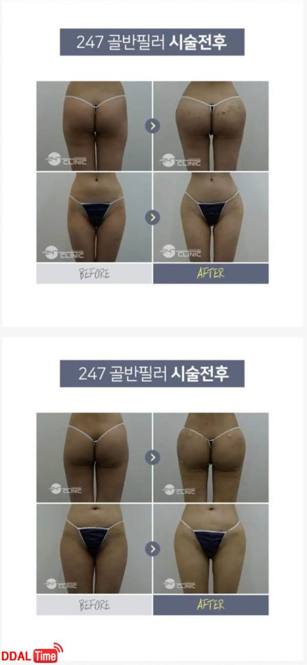 후방) 요즘 여자들 골반도 다 짭인 이유 이미지 #1
